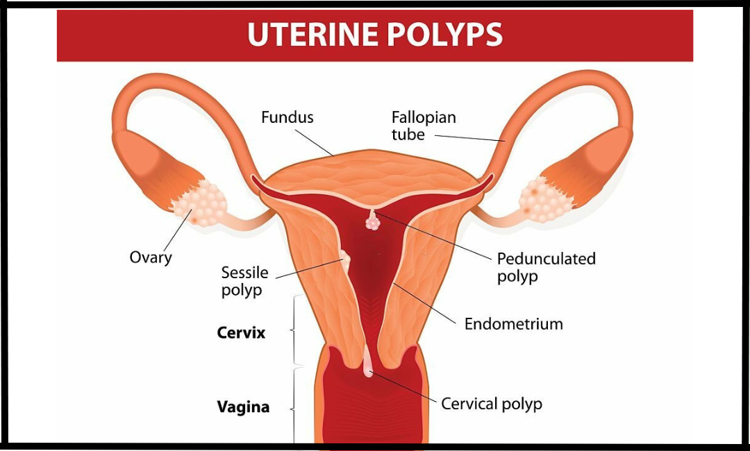 Uterine polyps